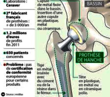 Prothèse de hanche Ceraver