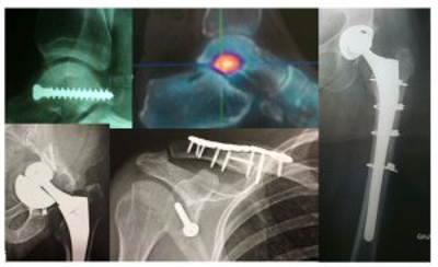 Prise en charge des fractures à la clinique Montagard