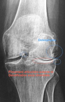 Traitement et Chirurgie Arthrose Genou Avignon, Nîmes, Cavaillon