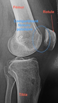 Arthrose du genou ou gonarthrose, définition et traitement