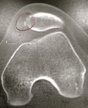 Scanner arrachement osseux ligament patello femoral medial