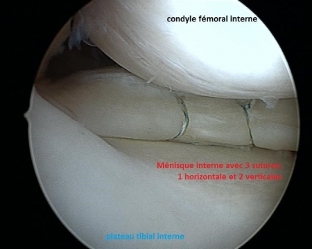 Traitement Lésions Ménisques. Opération genou Avignon, Carpentras ...