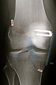 Reconstruction du ligament croisé antérieur technique All inside