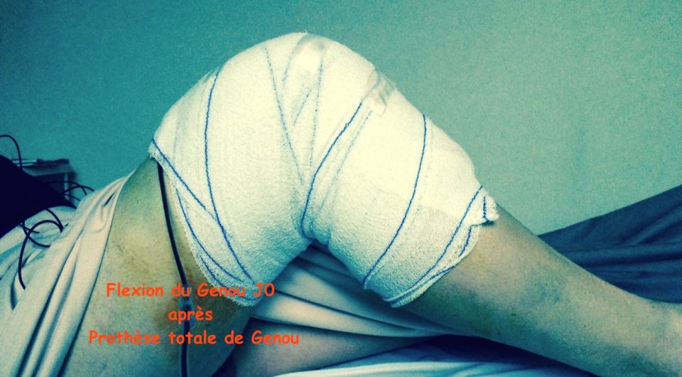 Réhabilitation rapide après chirurgie de la prothèse totale du genou. La photographie est un genou d'un patient.