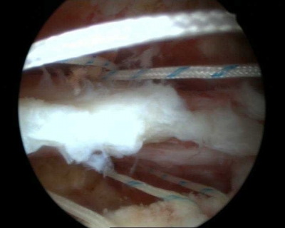 Passage des fils de suture