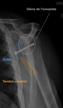 Figure 6 from Récidive d'instabilité glénohumérale après butée  coracoïdienne de type Bristow-Latarjet : quelle place pour les  stabilisations capsulaires arthroscopiques uni et bipolaires ?