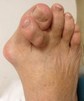 Plantar Fasciitis,Pes Planus,Mallet Toe,High Arched Feet,Heel Spur,Heel Pain,Hammer Toe,Hallux Valgus,Foot Pain,Foot Hard Skin,Foot Conditions,Foot Callous,Flat Feet,Fallen Arches,Diabetic Foot,Contracted Toe,Claw Toe,Bunions Hard Skin,Bunions Callous,Bunion Pain,Ball Of Foot Pain,Back Pain